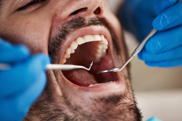Teeth Whitening in MT